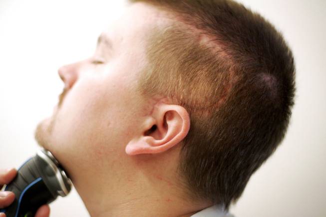 Chris Stones shaves before returns to work, his question mark-shaped scar prominent six weeks after his brain surgery Friday, September 4, 2009. Stones will return to work as a dealer at the Suncoast for the first time after his craniectomy was apparently successful in removing the part of his brain that was causing seizures. Stones has not had a seizure since his final surgery over six weeks ago.