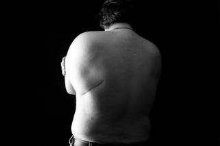 This man, who asked not to be identified, contracted a dangerous infection at a Las Vegas hospital where he had heart surgery. A second surgery was required to fix his lungs after they were ravaged by the infection, which left a large scar on his back. Photographed in Las Vegas Wednesday, August 4, 2010.