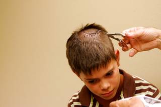 Dr. John Anson removes staples from an eight inch incision on Ben Gephart's head. Gephart underwent emergency surgery to repair damage done to his head when he was hit by a baseball.