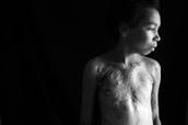 Burn Awareness Week