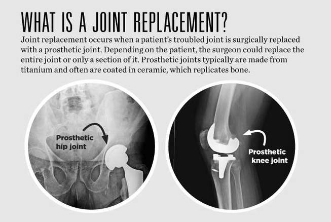 HCA joints HCA joints