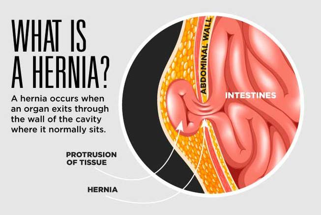 Hernias Hernias