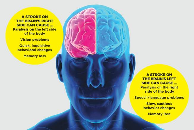 HCA stroke aftereffects native HCA stroke aftereffects native