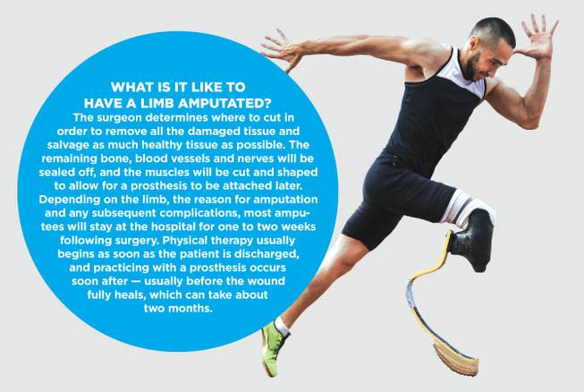 HCA limb loss native HCA limb loss native