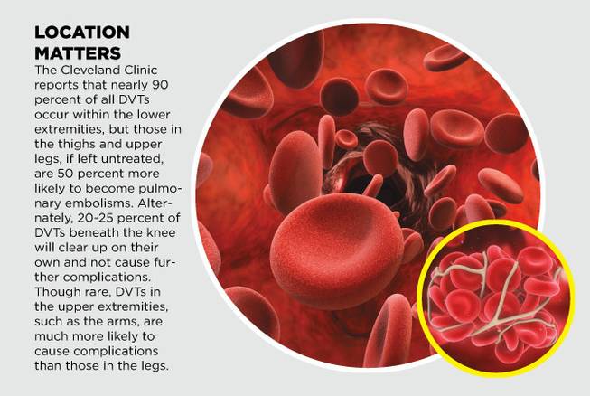 HCA blood clots and DVTs native HCA blood clots and DVTs native