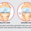 Photo: HCA bone spurs native Photo: HCA bone spurs native