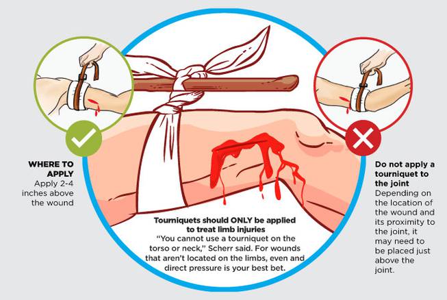 HCA how to make a tourniquet native HCA how to make a tourniquet native